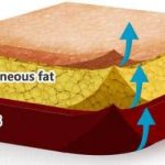 Dermal Filler Injection