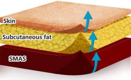 Dermal Filler Injection