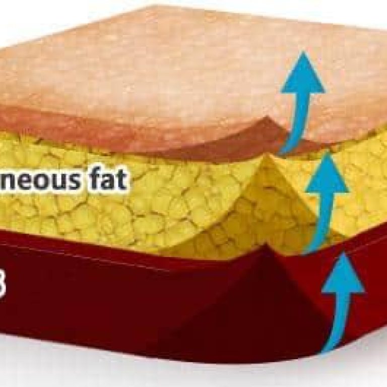Dermal Filler Injection